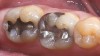 Figure 7  Preoperative photograph of an inlay in tooth No. 18 and an onlay on tooth No. 19