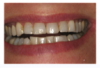 Fig 1. Pretreatment clinical photograph of the frontal smile.