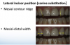 Fig 10. Evaluation of the lateral incisor position (canine substitution).