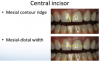 Fig. 8 Evaluation of the mesial contour ridge and the mesial-distal width of central incisors.