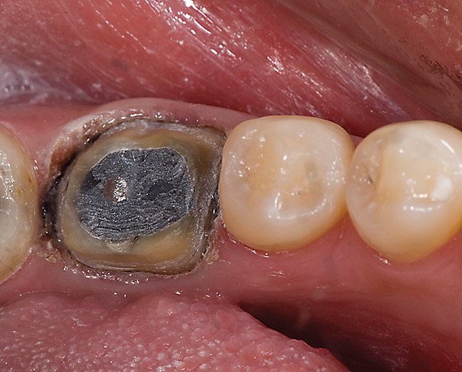 Cervical Margin Design