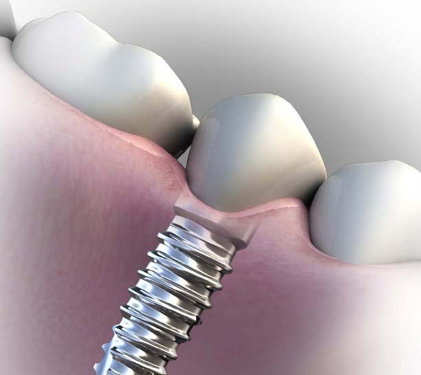 Planning Considerations and Retention Options for Implant Restorations eBook Thumbnail