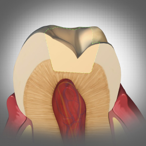 Understanding Today's Bulk-fill Posterior Composite Restoration Techniques eBook Thumbnail