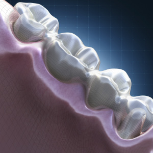 Managing Gingival Tissue During Crown Cases: Techniques in Soft-Tissue Displacement eBook Thumbnail