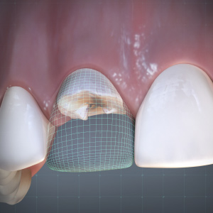 Managing Tooth Loss and Esthetics in a Single Visit eBook Thumbnail