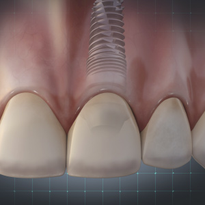 Implant-Supported Restoration Techniques eBook Thumbnail