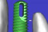 Figure 11b  By zooming in on the digital image, the implant-to-tooth distances can be assessed at the (A) crest and the (B) apex.