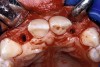 Figure 16a  After (A) the osteotomies were completed, (B) the implants were placed.