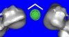 Figure 18a  The software allowed the implant’s antirotational hex to be positioned in the desired location and stock components to be evaluated.