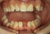 Figure 1  The patient presented with two missing mandibular central incisors, after completing orthodontic treatment.
