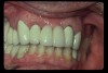 Figure 3  The patient presented with a failing, full-coverage fixed dental prosthesis from the maxillary right canine to the maxillary left canine. The width of the lateral incisors was very similar to the adjacent central incisors. The overall effect was unnatural. There were also considerable gingival margin height disparities.  Figure 4