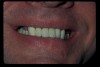 Figure 4  The patient’s full smile showed a lip aperture that limits the esthetic display to the coronal aspects of these teeth, and therefore, the treatment plan focused on correcting the width–length discrepancies of the crowns, not the gingival margin height disparities nor the issues of root exposure.
