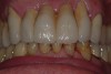 Figure 5  The treatment included expansion of each central incisor pontic and reduction in width of the lateral incisor crowns so that natural appearing width–length proportions (1.5 mm to 2 mm width differences) could be re-established.