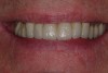 Figure 6  Postoperative smile view (dental laboratory technology by Jonathan Lee, Dental Ceramic Arts, Bryn Mawr, PA).