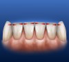 Figure 11  Diagrammatic representation of an anatomically correct incisal embrasure configuration for six mandibular anterior teeth. Note that this is a “lab bench” view (teeth positioned vertically upright) not a functional view.