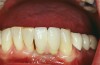 Figure 15  A mandibular anterior dental restoration with an incorrectly placed incisal embrasure between the left central and lateral incisors, known as the “picket fence” appearance. A retracted view of the same patient reveals a two-unit, fixed, implant-supported restoration fabricated with great skill in many other aspects.