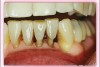 Figure 16  The patient presented with mandibular left central and lateral incisors with compromised root support in the region of the cementoenamel junction. The treatment plan was for splinted dental crowns.