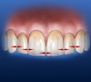 Figure 20  Diagram illustrating the natural anatomical position and progression of incisal embrasures on youthful, intact maxillary anterior teeth.