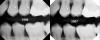 Figure 7  Nonprogression lesions in a patient who is currently at low risk, although it is obvious that there had been a period of high risk.