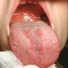 Figure 1  Evidence of candidiasis in the form of erythematous, atrophic patches on the dorsal surface of the tongue (median rhomboid glossitis) and erythema of the soft palate. The patient was using an inhaler and wearing a denture and was a smoker.
