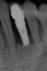Figure 3  Preoperative radiograph of the failing implant in the site of tooth No. 22.