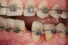 Figure 9: Orthodontic distraction osteogenesis to develop the implant site of tooth No. 23.