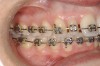 Figure 12  Right buccal view showing posterior occlusion established, canine guidance and proper space appropriation around peg lateral tooth No. 7, and intruded worn incisors.