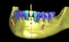 Figure 15  Presurgical 3-dimensional CT scan diagnostic planning for implant No. 23. Note the anticipated dehiscence at the facial aspect of the implant.