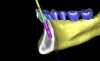 Figure 16  A cross-sectional view of postorthodontic site development at No. 23 position. Sufficient bone has been developed to accommodate implant placement in an optimal prosthetic position. Simultaneous GBR is planned at the coronal most portion of the implant per anticipated dehiscence.
