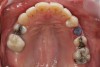 Figure 6g  Jackscrews were activated 0.5 mm/day after 5-day latency period. Note pure translation of segments without tipping. Result 8 months postsurgery. Tooth No. 12 was converted to a canine, and an implant was placed in regenerate bone. Note amount of alveoloskeletal correction and increase in volume of maxillary arch. Also note in Figure 6c and Figure 6c the amount of protraction of maxillary anterior segments while anchorage was maintained in posterior segment. Restorative dentist: Michael E. Carter, DDS.