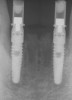 Figure 4  Tapered implants with conical transgingival abutments and temporary cylinders in place.