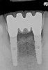 Figure 9  The 4-year postoperative radiograph.