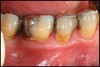 Figure 3a   patient in posttreatment periodontal maintenance program returned with (A) isolated bleeding on probing;