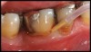 Figure 3c  The site was treated by localized scaling and root planing, followed by use of Arestin (minocycline microspheres).