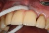 Figure 4b  Use of a proxi-brush and large-diameter floss to perform plaque control around an implant-supported/retained prosthesis