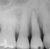 Figure 1  Tooth No. 5 showing advanced periodontal bone loss and a widened periodontal ligament space.