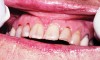 Figure 2 Dental caries is usually seen in cervical and incisal surfaces.