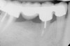 Figure 8  Same case as in Figure 7 showing teeth Nos. 28 and 29. Note that tooth No. 28 was included into the four-unit restoration, and the small radiolucency on the distal tooth No. 29, which was associated with a root fracture.