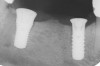 Figure 9  Extraction of teeth Nos. 29 and 31 with immediate implants (Straumann USA, Waltham, MA) placed into the site.