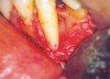 Figure 11  Very large osseous lesion exposed on tooth No. 22 after scaling and degranulation.