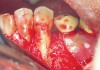 Figure 13  The case seen in Figure 11 on 6-year re-entry showing complete distal bone fill.