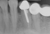 Figure 14  Radiographic view of the case seen in Figure 13 showing complete bone fill of the periodontal defect (the bone graft used was mostly radiolucent).