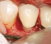 Figure 15  A one wall periodontal osseous defect.