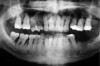 Figure 16  Panoramic radiograph showing generalized advanced bone loss. In the lower left quadrant, teeth Nos. 17 through 20 were lost many years earlier, and the bone level has a significantly more coronal position than the corresponding lower right quadrant where the teeth were retained.