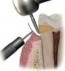 Figure 1  Use of gingival protector during the finishing of a cervical restoration to prevent trauma to the gingiva.