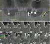 Figure  5  A cone-beam scan was performed prior to the lateral window sinus lift.