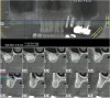 Figure  6   A cone-beam scan was performed after the lateral window sinus lift.