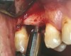 Figure 7a  Alternating osteotomes with variable conicity used to perform the alveolar remodeling in the area of tooth No. 15.