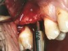 Figure 7b  Alternating osteotomes with variable conicity used to perform the alveolar remodeling in the area of tooth No. 15.