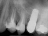 Figure 12  Preoperative radiograph shows fractured tooth No. 24.